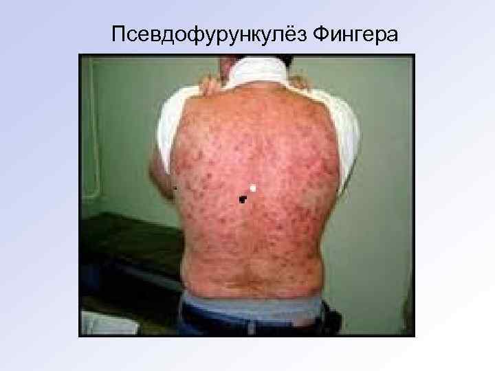 Псевдофурункулёз Фингера 