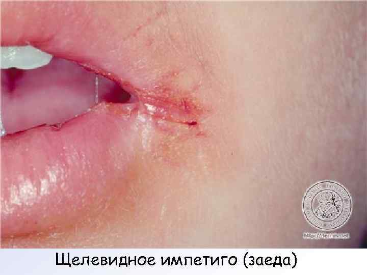 Щелевидное импетиго (заеда) 