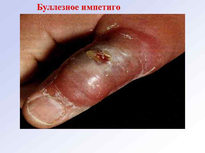 Буллезное импетиго 