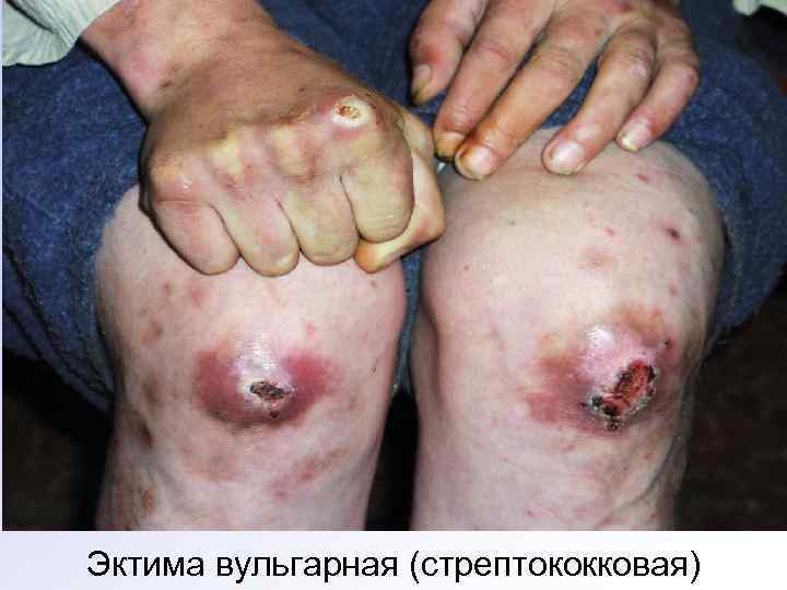 Эктима вульгарная (стрептококковая) 