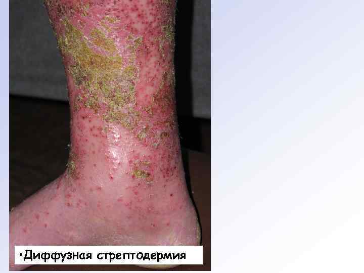  • Диффузная стрептодермия 