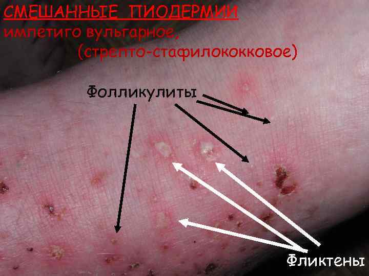 СМЕШАННЫЕ ПИОДЕРМИИ импетиго вульгарное,   (стрепто-стафилококковое)  Фолликулиты     