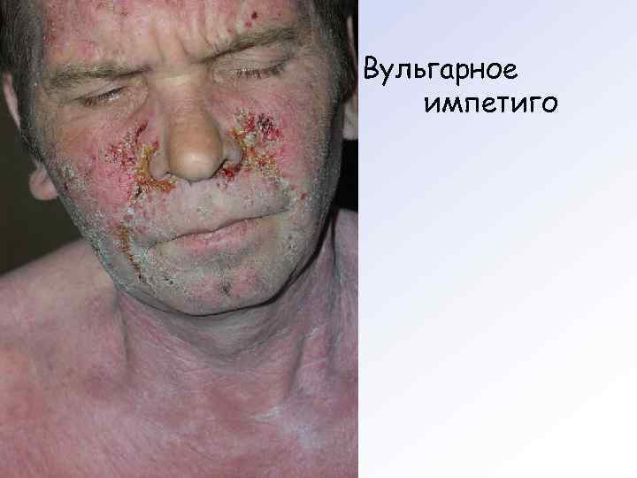 Вульгарное импетиго 