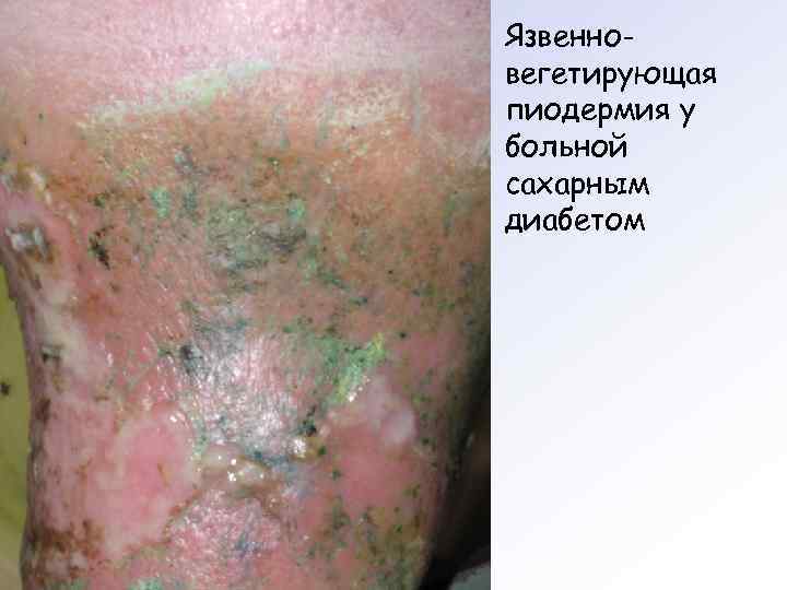 Язвенно- вегетирующая пиодермия у больной сахарным диабетом 