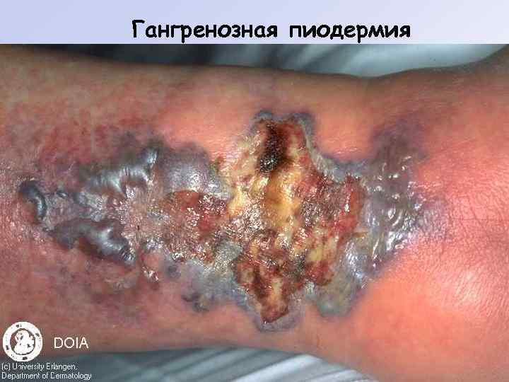 Гангренозная пиодермия 