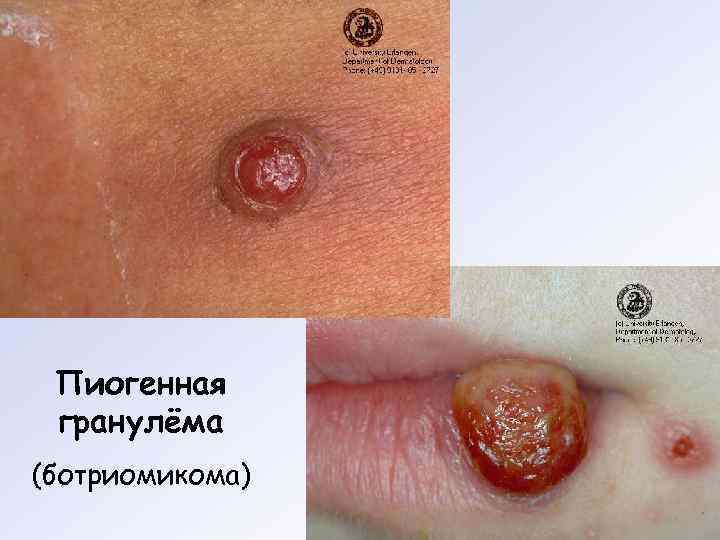 Пиогенная гранулёма (ботриомикома) 