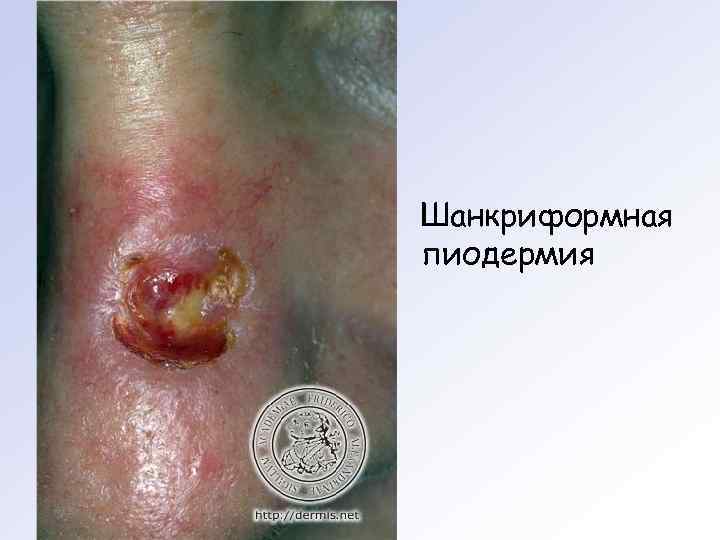 Шанкриформная пиодермия 