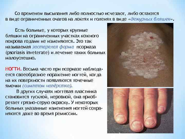   Со временем высыпания либо полностью исчезают, либо остаются в виде ограниченных очагов