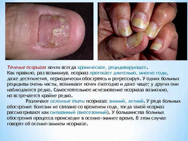 Течение псориаза почти всегда хроническое, рецидивирующее. Как правило, раз возникнув, псориаз протекает длительно, многие