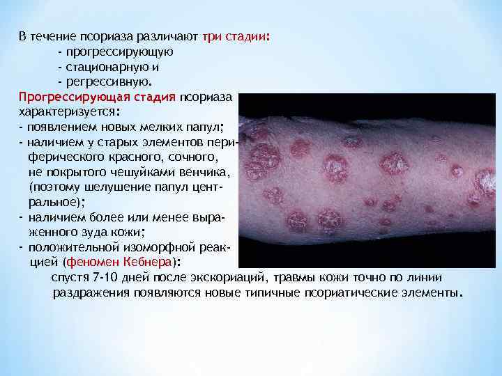 В течение псориаза различают три стадии:   - прогрессирующую  - стационарную и