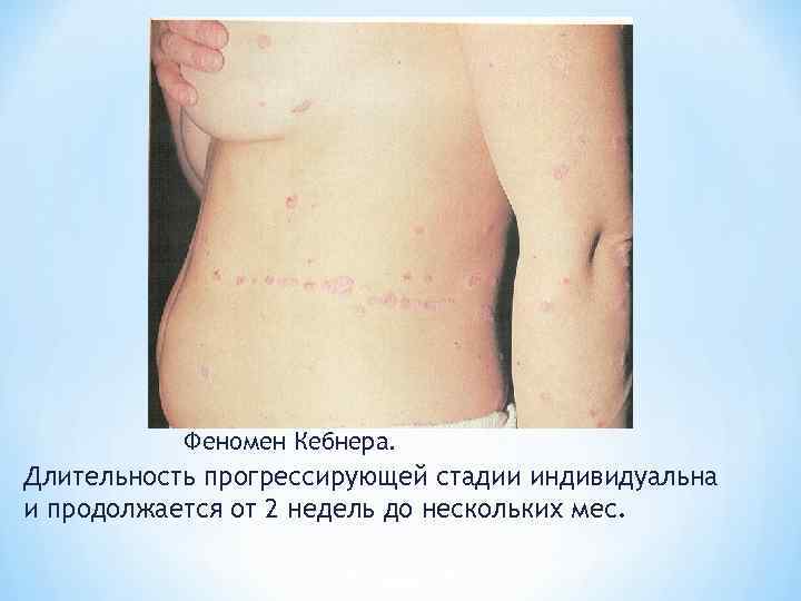   Феномен Кебнера. Длительность прогрессирующей стадии индивидуальна и продолжается от 2 недель до