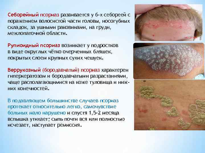 Себорейный псориаз развивается у б-х себореей с поражением волосистой части головы, носогубных складок, за
