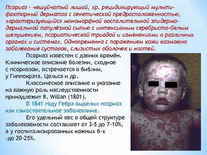 Псориаз - чешуйчатый лишай, хр. рецидивирующий мульти- факторный дерматоз с генетической предрасположенностью, характеризующийся мономорфной