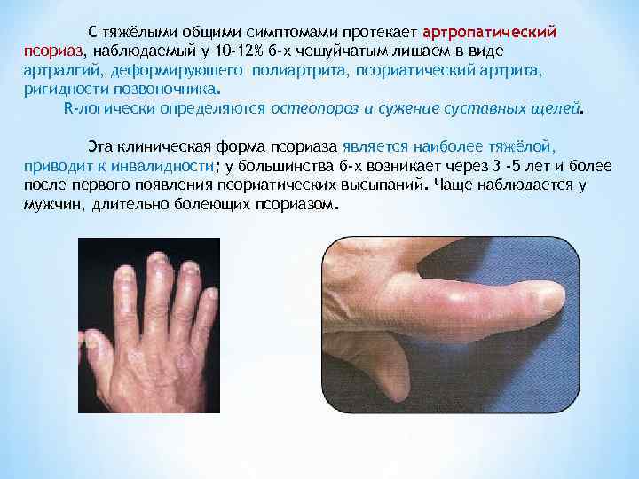  С тяжёлыми общими симптомами протекает артропатический псориаз, наблюдаемый у 10 -12% б-х
