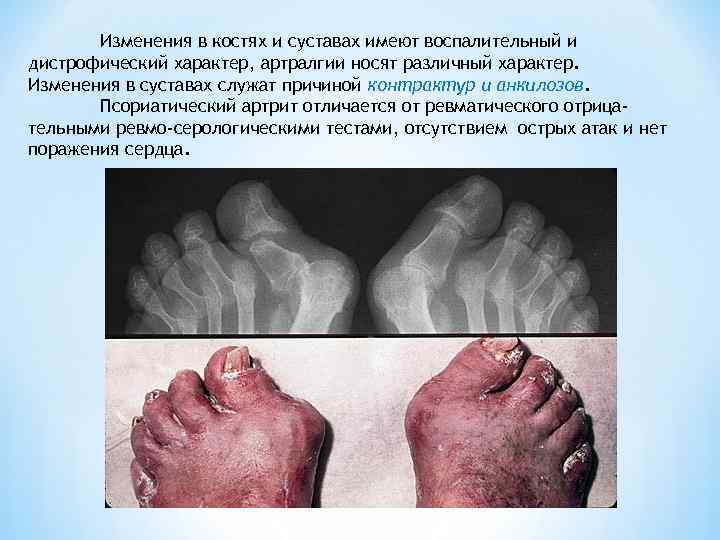   Изменения в костях и суставах имеют воспалительный и дистрофический характер, артралгии носят