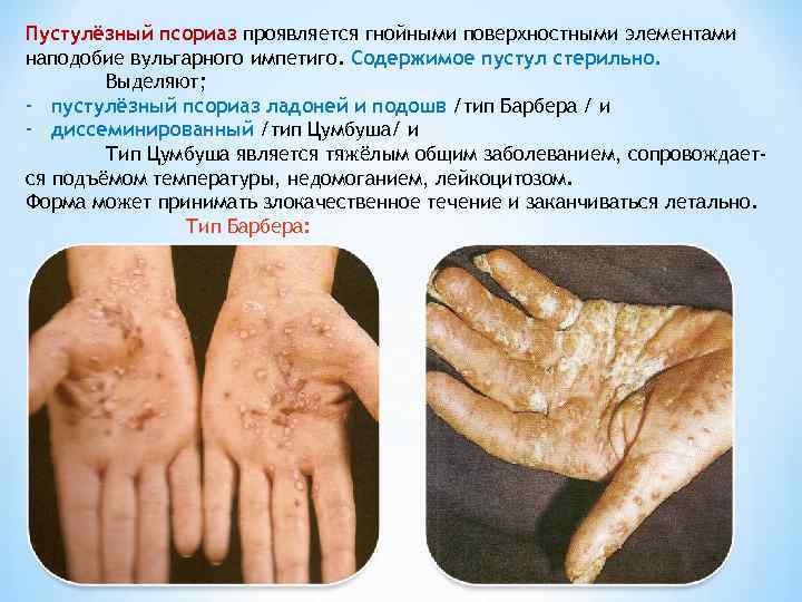 Пустулёзный псориаз проявляется гнойными поверхностными элементами наподобие вульгарного импетиго. Содержимое пустул стерильно.  