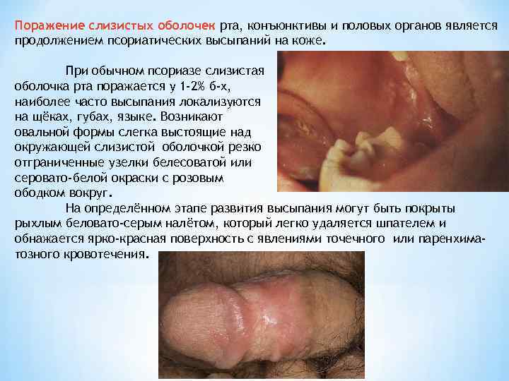 Поражение слизистых оболочек рта, конъюнктивы и половых органов является продолжением псориатических высыпаний на коже.