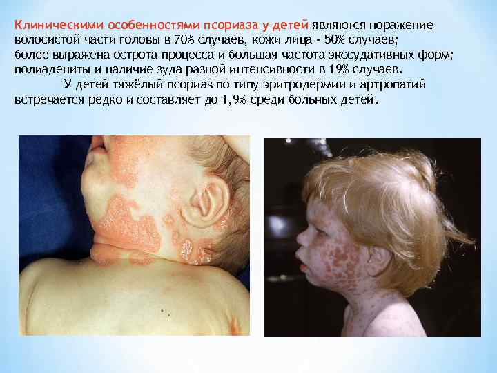 Клиническими особенностями псориаза у детей являются поражение волосистой части головы в 70% случаев, кожи