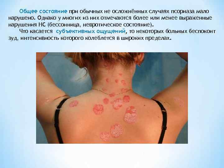   Общее состояние при обычных не осложнённых случаях псориаза мало нарушено. Однако у