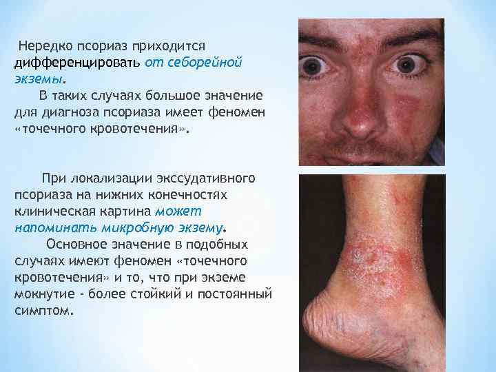  Нередко псориаз приходится дифференцировать от себорейной экземы. В таких случаях большое значение для