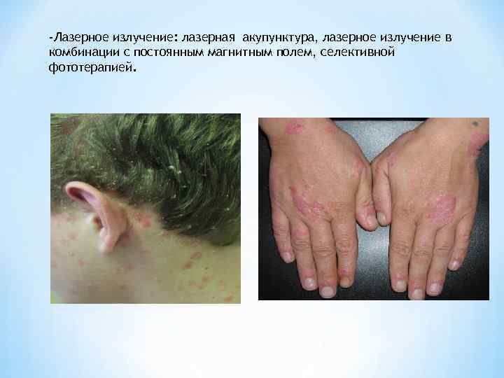 -Лазерное излучение: лазерная акупунктура, лазерное излучение в комбинации с постоянным магнитным полем, селективной фототерапией.