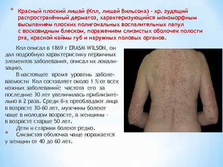  *  Красный плоский лишай (Кпл, лишай Вильсона) – хр. зудящий распространённый дерматоз,