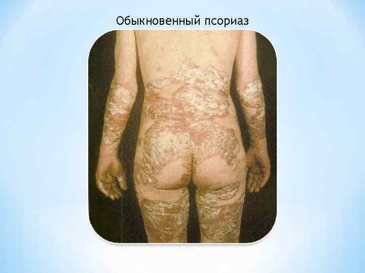 Обыкновенный псориаз 