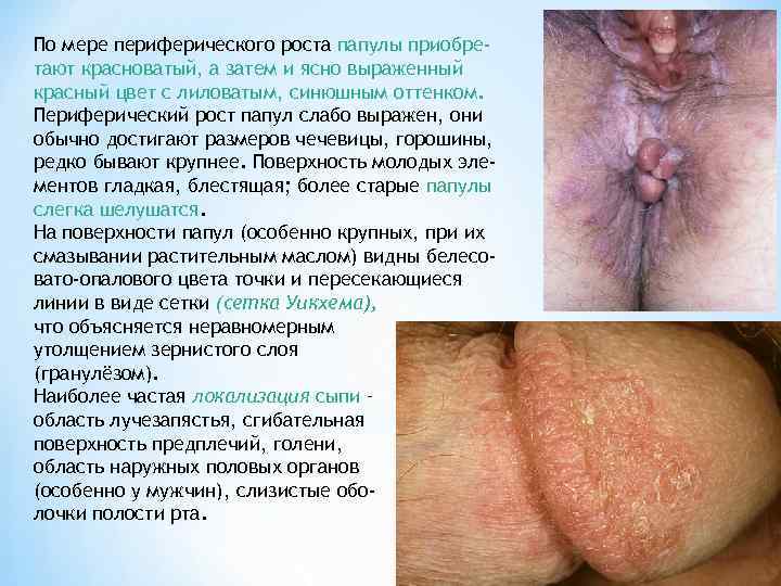 По мере периферического роста папулы приобре- тают красноватый, а затем и ясно выраженный красный