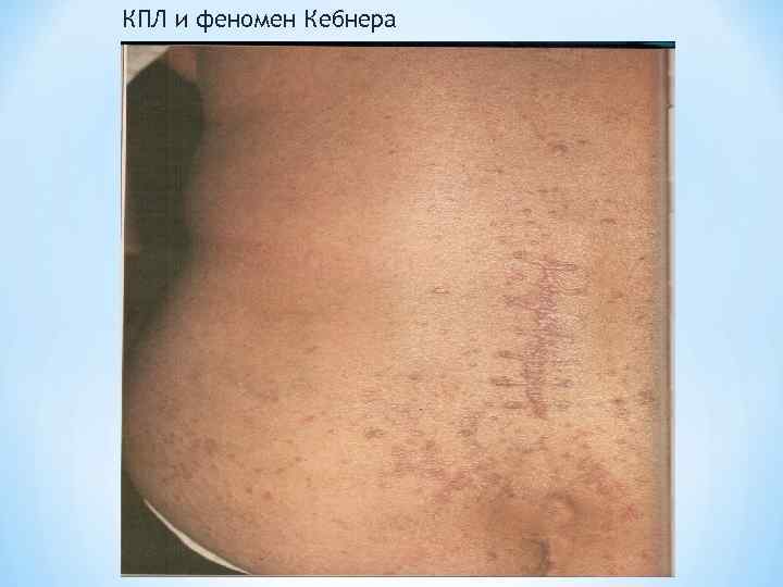 КПЛ и феномен Кебнера 