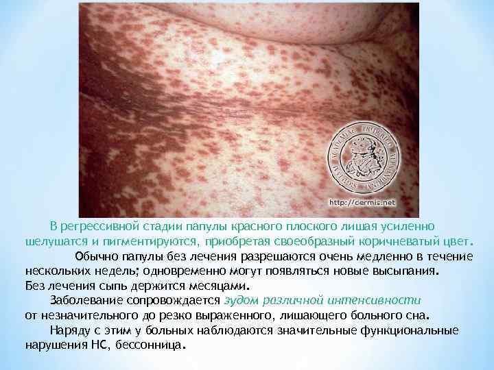   В регрессивной стадии папулы красного плоского лишая усиленно шелушатся и пигментируются, приобретая