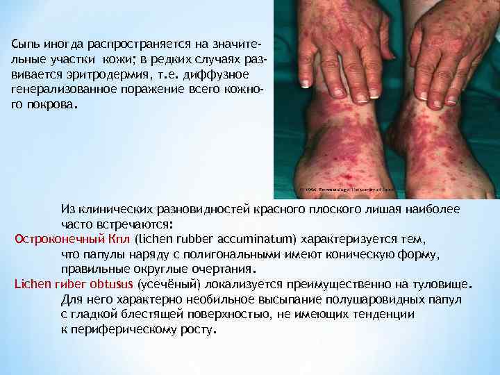 Сыпь иногда распространяется на значите- льные участки кожи; в редких случаях раз- вивается эритродермия,