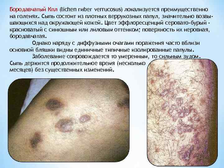 Бородавчатый Кпл (lichen гиbег verrucosus) локализуется преимущественно на голенях. Сыпь состоит из плотных веррукозных