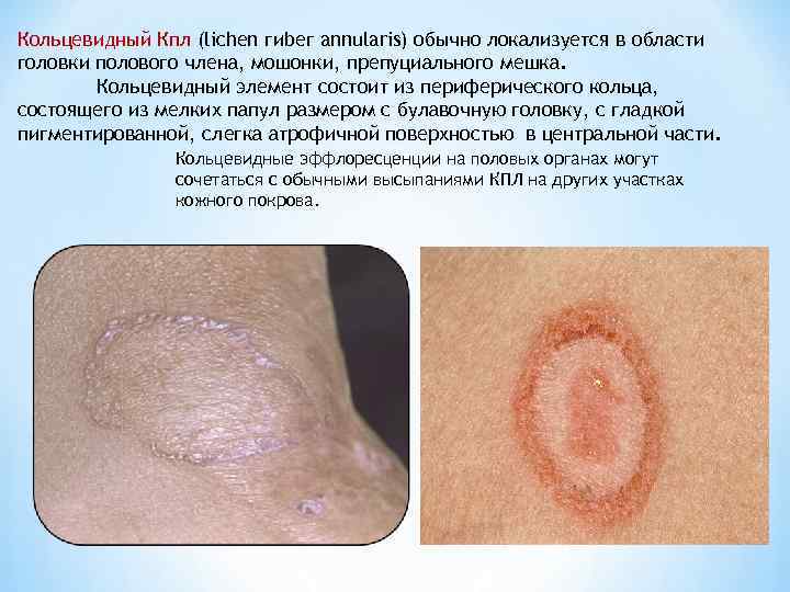Кольцевидный Кпл (lichen гиbег annularis) обычно локализуется в области головки полового члена, мошонки, препуциального