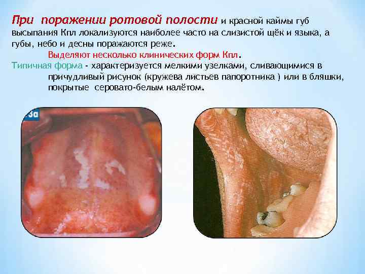 При поражении ротовой полости    и красной каймы губ высыпания Кпл локализуются