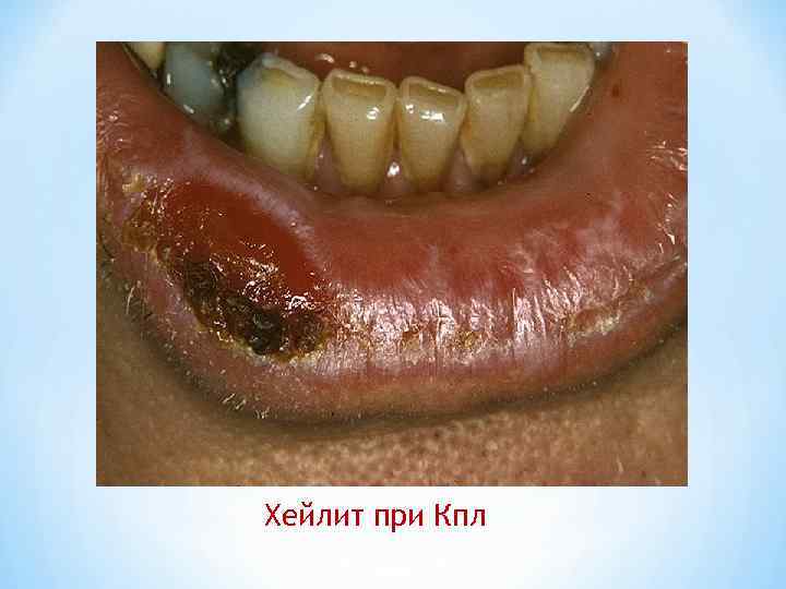 Хейлит при Кпл 