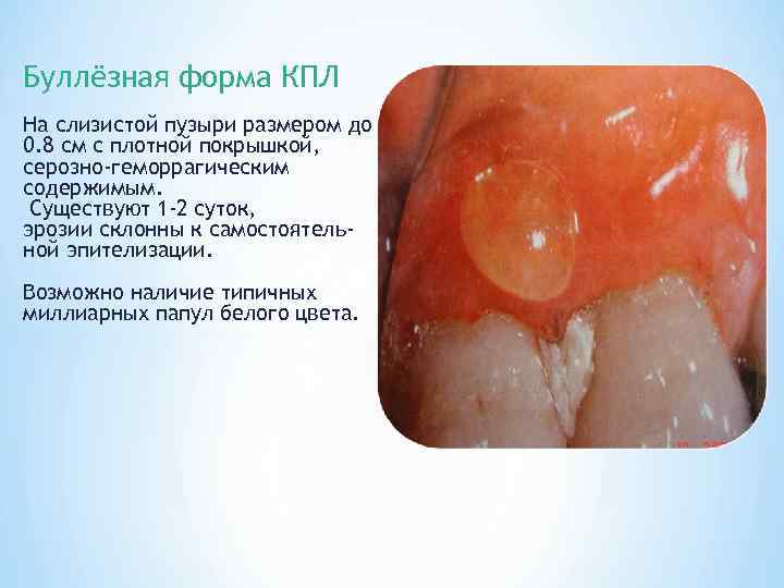 Буллёзная форма КПЛ На слизистой пузыри размером до 0. 8 см с плотной покрышкой,