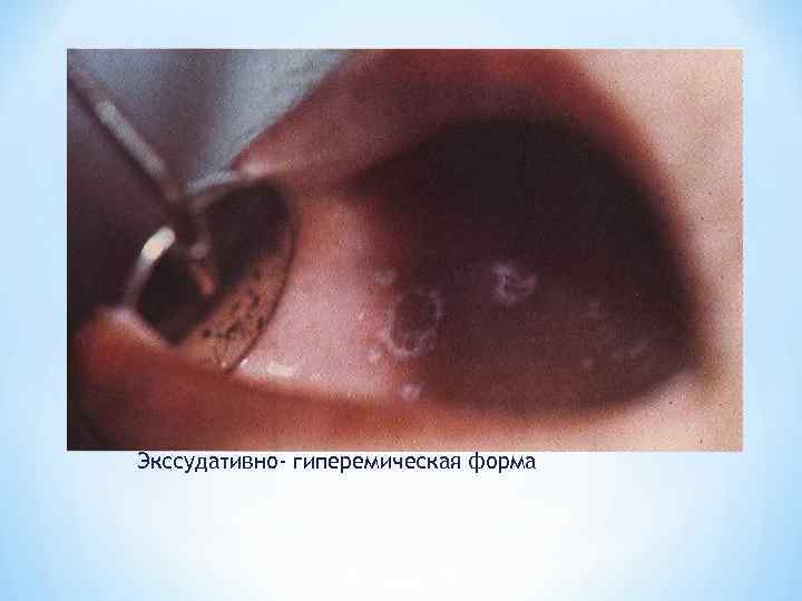 Экссудативно- гиперемическая форма 