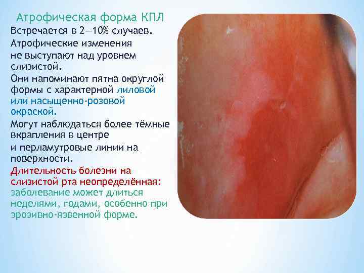  Атрофическая форма КПЛ Встречается в 2— 10% случаев. Атрофические изменения не выступают над