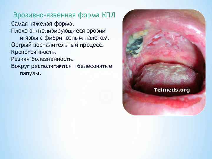 Эрозивно-язвенная форма КПЛ Самая тяжёлая форма. Плохо эпителизирующиеся эрозии  и язвы с фибринозным