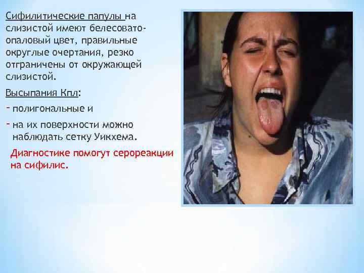 Сифилитические папулы на слизистой имеют белесовато- опаловый цвет, правильные округлые очертания, резко отграничены от