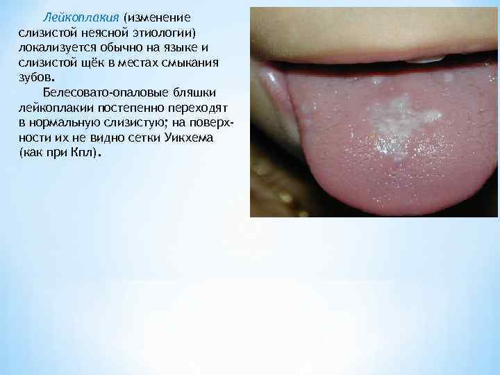   Лейкоплакия (изменение слизистой неясной этиологии) локализуется обычно на языке и слизистой щёк