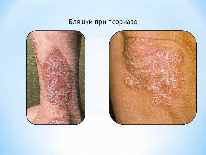 Бляшки при псориазе 