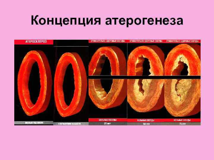 Концепция атерогенеза 