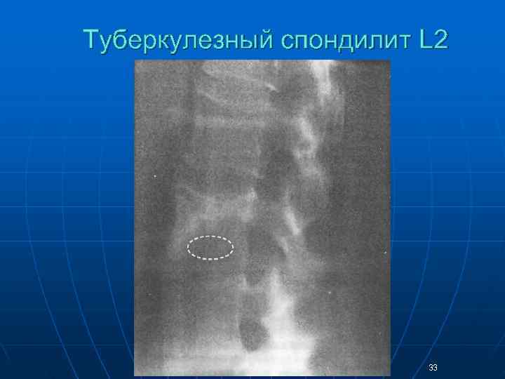 Туберкулезный спондилит L 2     33 