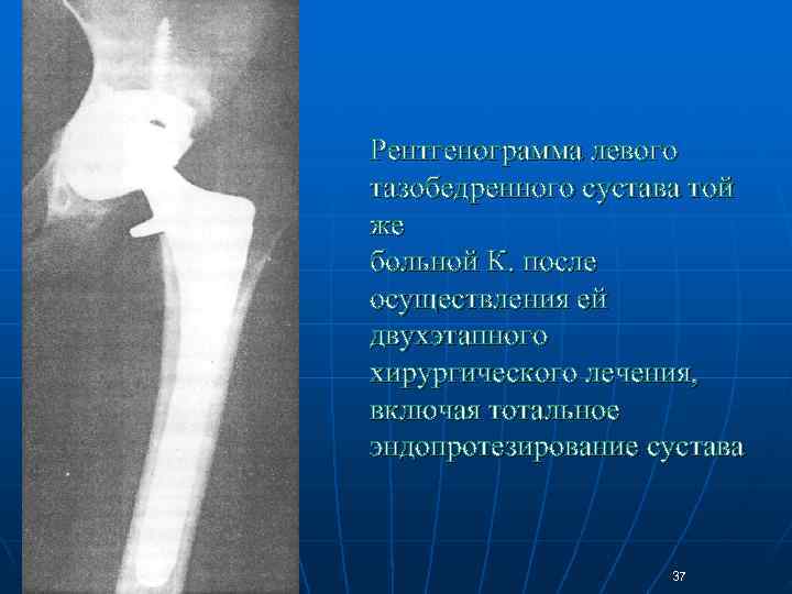Рентгенограмма левого тазобедренного сустава той же больной К. после осуществления ей двухэтапного хирургического лечения,