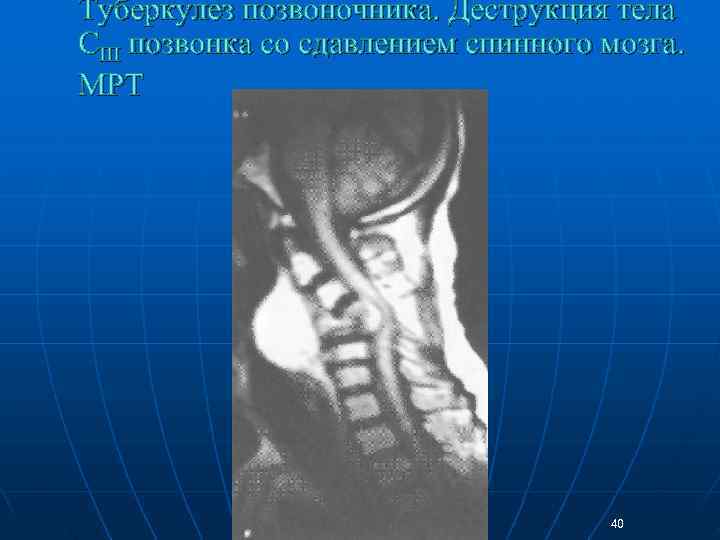 Туберкулез позвоночника. Деструкция тела СIII позвонка со сдавлением спинного мозга.  МРТ  