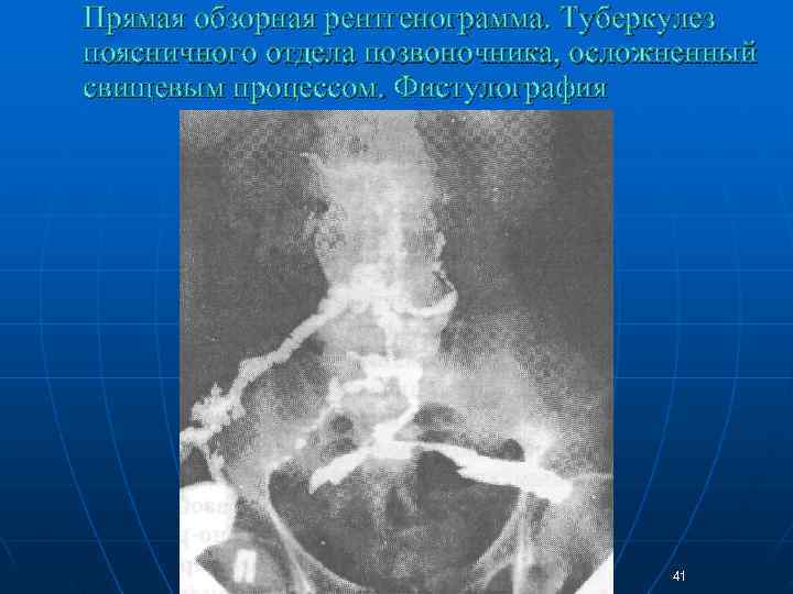 Прямая обзорная рентгенограмма. Туберкулез поясничного отдела позвоночника, осложненный свищевым процессом. Фистулография   