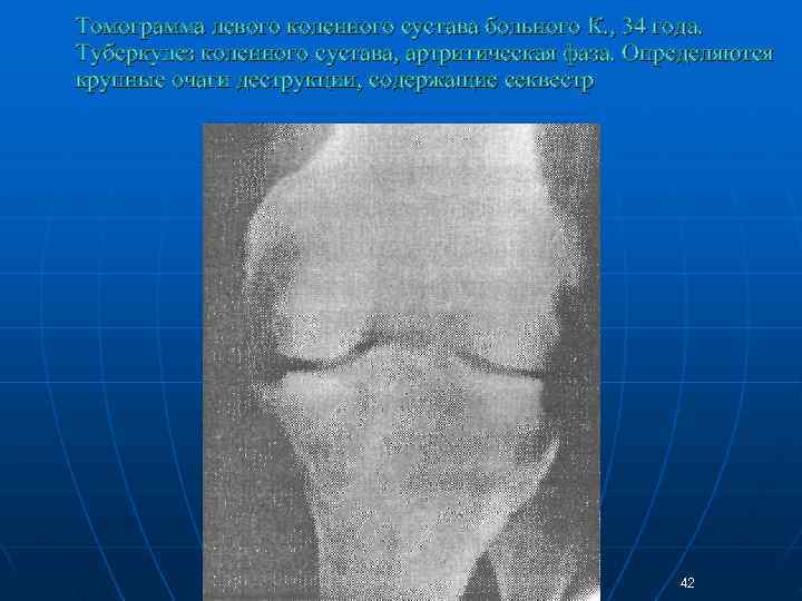 Томограмма левого коленного сустава больного К. , 34 года.  Туберкулез коленного сустава, артритическая