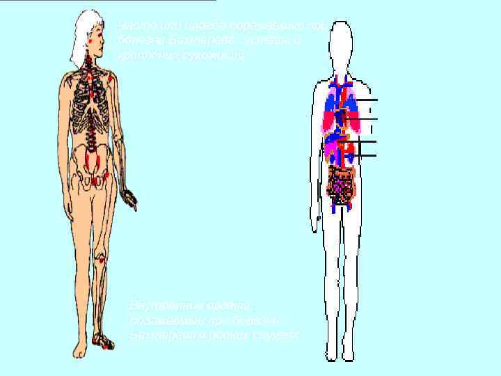 Часто или иногда поражаемые при болезни Бехтерева суставы и крепления сухожилий Внутренние органы, 