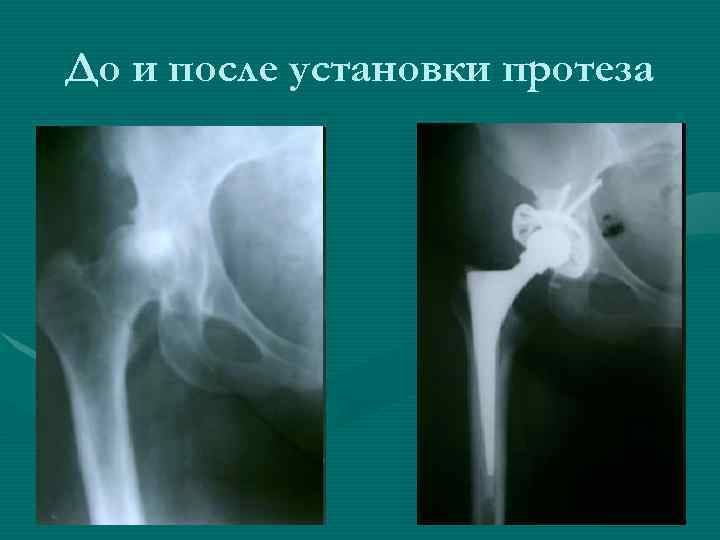 До и после установки протеза 